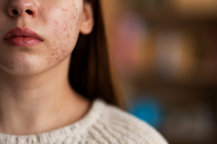 Konsumsi Gula vs Kecantikan Kulit: Dampak Gula Berlebih